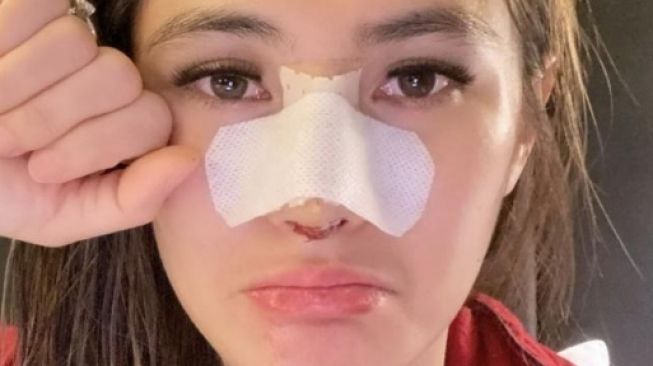 Artis Jalani Operasi Hidung (Instagram/@angelalee87)