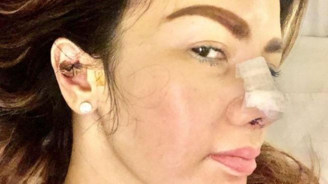 Artis Jalani Operasi Hidung (Instagram/@barbiekumalasari)