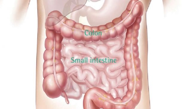 Ilustrasi Kanker Kolorektal (Dok. Parkway Cancer Centre)