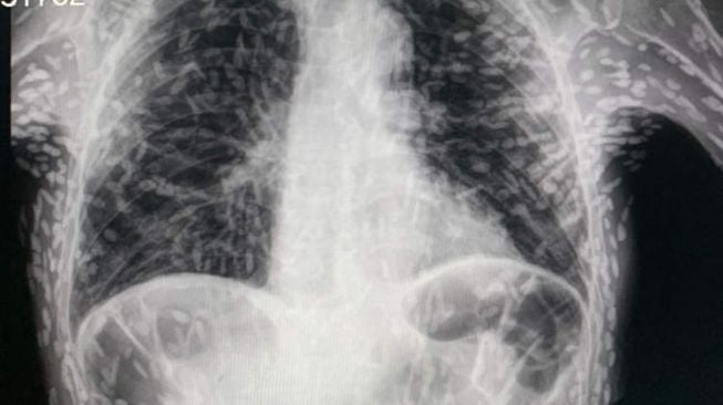 Menkes Budi: Balita Raya Meninggal Bukan karena 1 Kg Cacing, Tapi Sepsis Akibat Infeksi Kronis