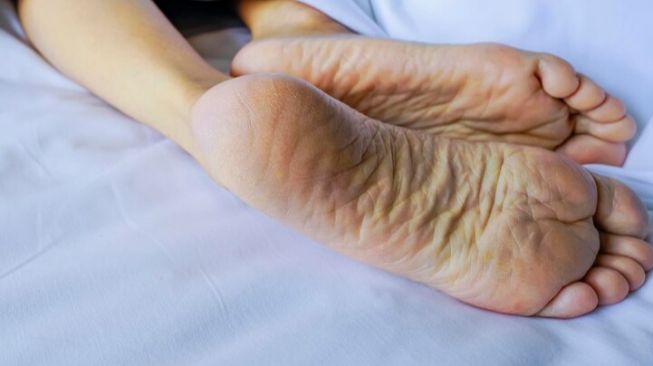 4 Bahan Alami yang Ampuh untuk Mengatasi Kapalan di Tangan dan Kaki