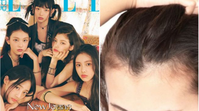 Terobsesi Mirip NewJeans hingga LE SSERAFIM, Tren Operasi Garis Rambut di Korea Meningkat