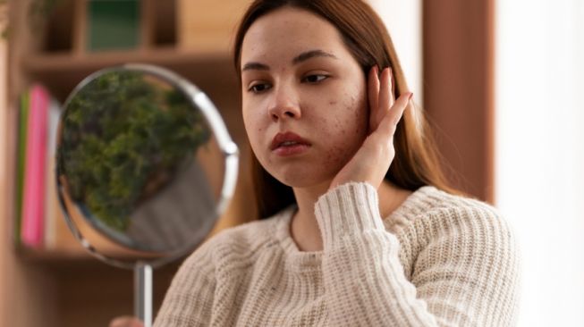 6 Tips Memilih Krim Penghilang Bekas Jerawat, Jangan Sembarangan Beli Produk Viral