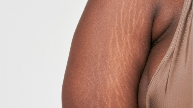 Siapa Bilang Stretch Mark Gak Bisa Hilang? Coba Lakukan 5 Tips Alami Ini