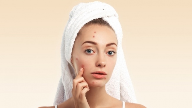 Pemilik Acne Prone Skin, Hindari Makanan Ini Jika Tak Mau Jerawat Meradang!