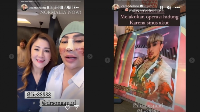 Caren Delano operasi hidung lagi (Instagram/@carendelano)