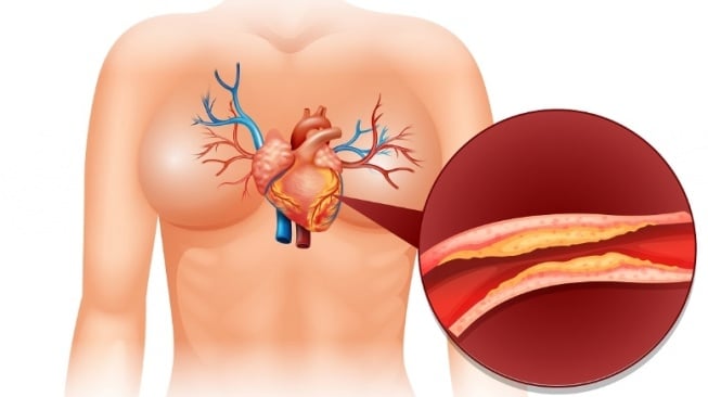 Tips Hindari Nyeri Dada Berulang pada Pasien Penyakit Jantung yang Sudah Pasang Ring