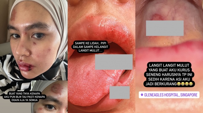 Kondisi Kartika Putri terserang penyakit misterius.  (Instagram/kartikaputriworld)