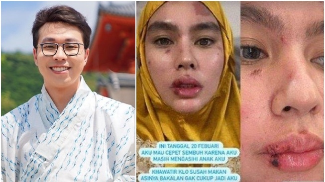 Dr.  Richard Lee questions Kartika Putri's reasons for seeking treatment in Singapore (Instagram)