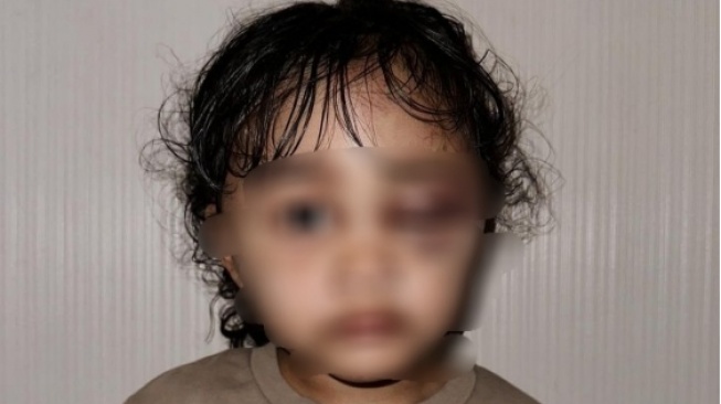 Wajah anak selebgram Emy Aghnia yang babak belur usai diduga dianiaya pengasuhnya (Instagram/emyaghnia)