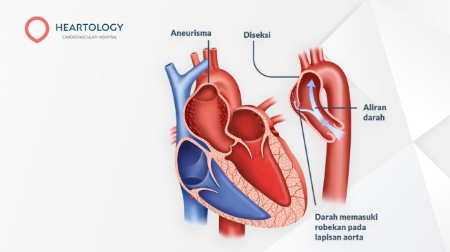 Mengenal Aneurisma Aorta, Bom Waktu Tanpa Gejala yang Bisa Mengakibatkan Kematian