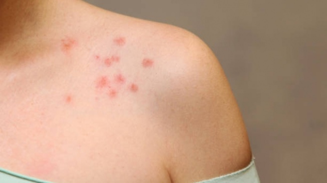 7 Fakta Penting Herpes Zoster: dari Risiko hingga Cara Pencegahannya yang Harus Diketahui