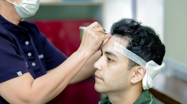 Aktor Rizky Alatas tengah menjalani proses transplantasi rambut. [Farmanina Clinic]