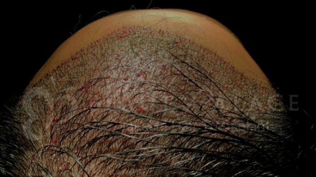 Jakarta Hair Transplant Menggugah Kembali Tren Transplantasi Rambut di Indonesia