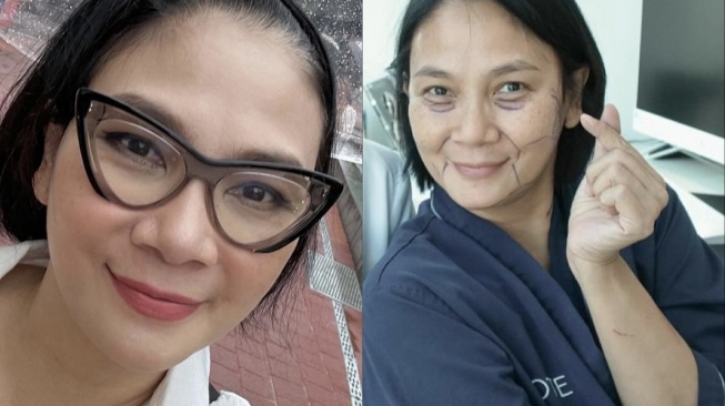 Dian Nitami Pamer Penampilan Baru Usai Operasi Facelift di Korea, Dipuji Tetap Cantik Natural