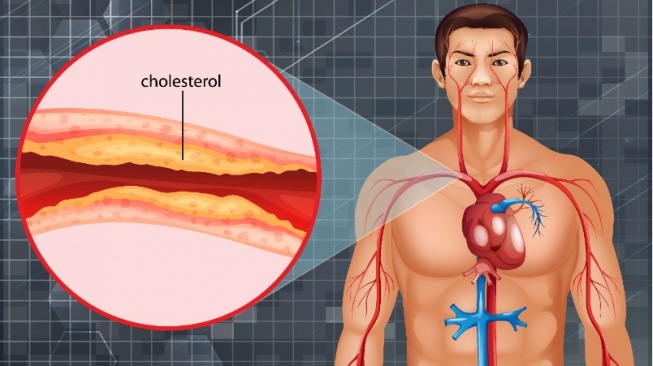 Diet Kolesterol, 5 Makanan Enak yang Wajib Dikonsumsi dan Dihindari