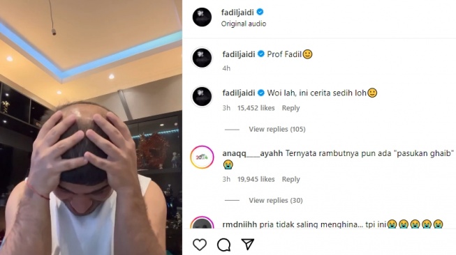 Fadil Jaidi lakukan prosedur tanam rambut usai alami kebotakan (Instagram/fadiljaidi)