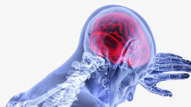 Revolusi Diagnosis Stroke: Teknologi DSA Ungkap Detail Pembuluh Darah Otak!