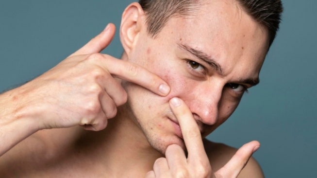 4 Rekomendasi Acne Spot Treatment yang Ampuh Hempas Jerawat Membandel