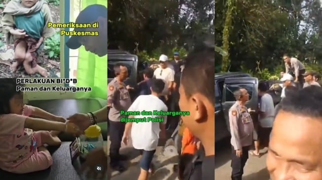 Bocah perempuan di Nias Selatan diduga dianiaya sampai kaki patah dan bengkok. [Instagram/@mediagramindo ; X/@neVerAl0nely]