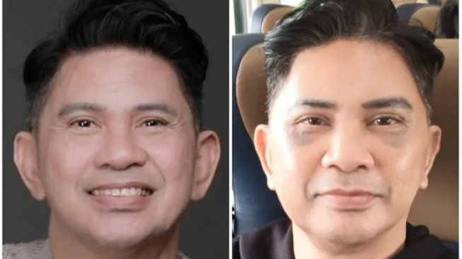 Deretan Artis yang Lakukan Facelift, Terbaru Iis Dahlia