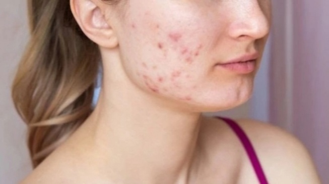 5 Rekomendasi Skincare Penghilang Bopeng di Wajah, Mulai Rp50 Ribuan Kulit Bisa Mulus