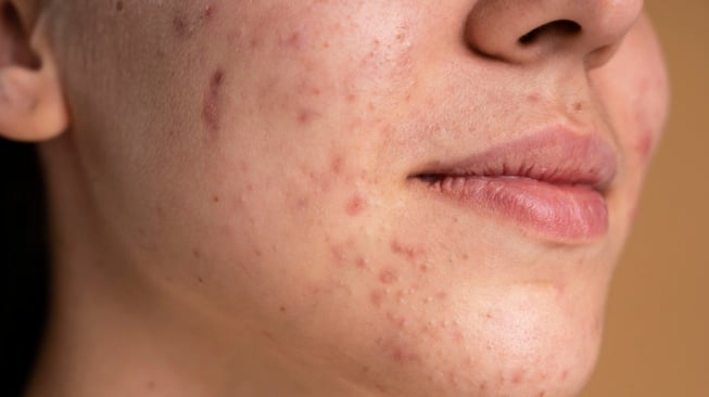 ilustrasi skin barrier rusak (freepik)