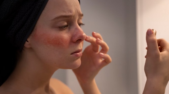 Kolesterol tinggi dapat ditandai dengan lichen planus atau ruam gatal berwarna merah atau ungu yang mengilap di wajah (Freepik/freepik)
