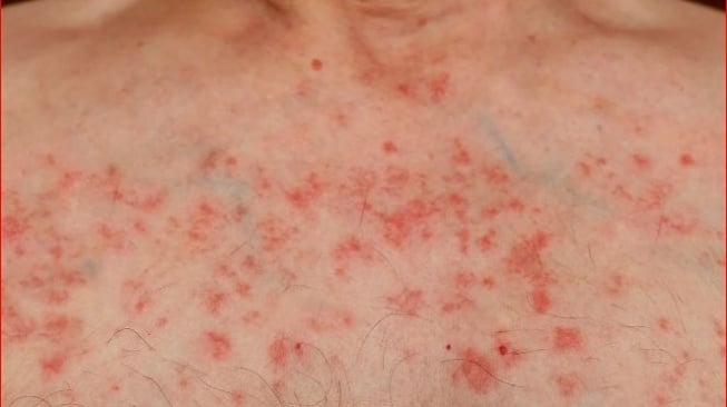 Pertanda di Kulit yang Mesti Diwaspadai Penyebab Leukimia, Diantaranya Kurap