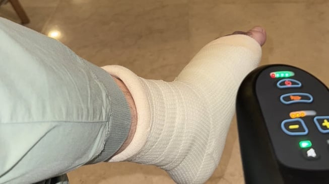 Irwansyah membagikan foto kakinya yang patah (Instagram)