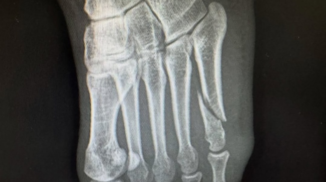Hasil rontgen kaki Irwansyah yang diduga patah di salah sati jari kaki kirinya (Instagram)