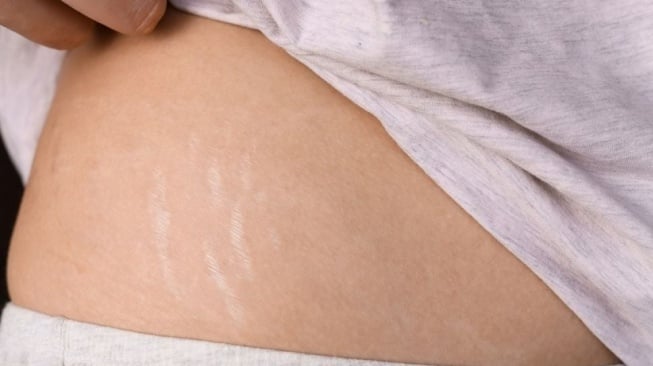 Ilustrasi stretch mark. (Envato Elements)