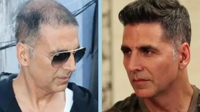 Akshay Kumar menjadi salah satu aktor Bollywood yang melakukan transplantasi rambut. [Instagram]