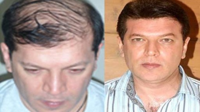 Aditya Pancholi menjadi salah satu aktor senior Bollywod yang melakukan transplantasi rambut. [Instagram]