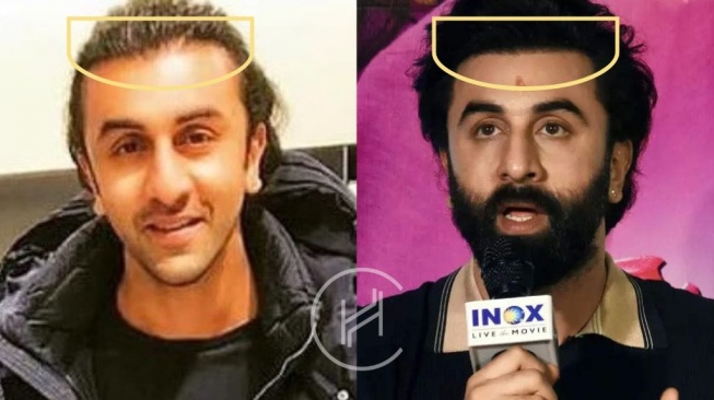 Ranbir Kapoor menjadi salah satu aktor Bollywood yang lakukan transplantasi rambut. [Instagram]