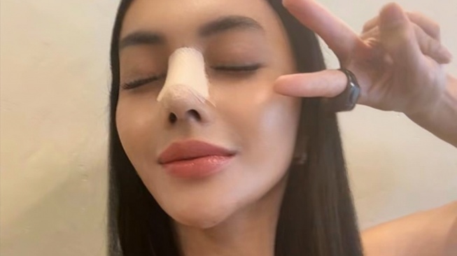 Denada saat menjalani operasi plastik di bagian hidung (Instagram)