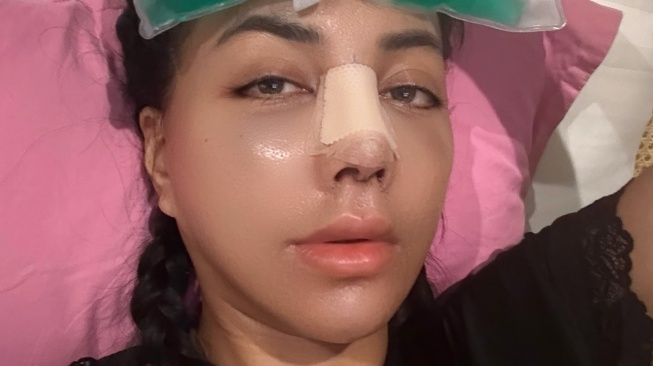 Denada saat menjalani operasi plastik di bagian hidung (Instagram)