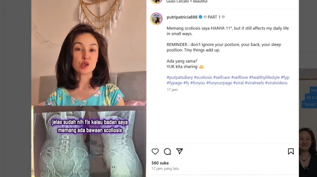 Putri Patricia Idap Skoliosis 11 Derajat, Sakitnya Sampai Tak Bisa Angkat Kaki. [Instagram/putripatricia888]