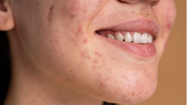 7 Rekomendasi Sunscreen untuk Menghilangkan Bekas Jerawat, Ampuh dan Tidak Lengket