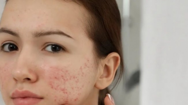 4 Calming Serum Penyelamat Kulit Kemerahan Akibat Skin Barrier Rusak!