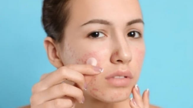4 Acne Patch Atasi Jerawat Bernanah, Harga Terjangkau di Bawah Rp30 Ribuan!