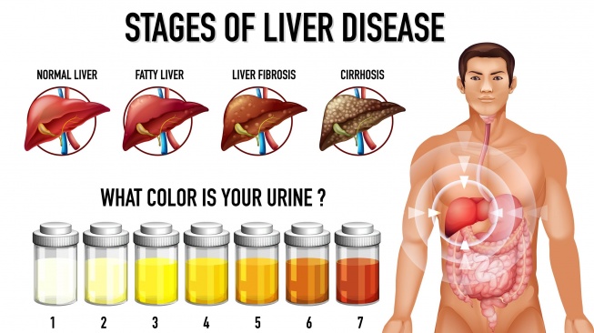 ilustrasi fatty liver (freepik/brgfx)