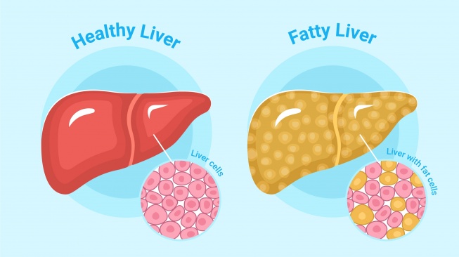 ilustrasi fatty liver (freepik)