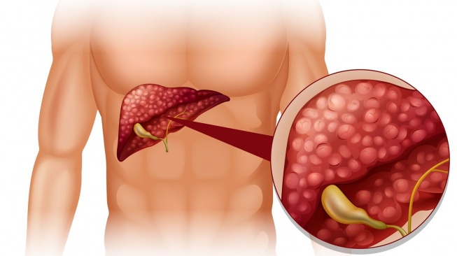 ilustrasi fatty liver (freepik/brgfx)