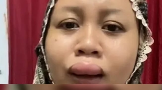 4 Fakta Viral Bibir Bengkak 3 Jam Sebelum Akad Nikah, Pengantin Wanita Asal Bekasi Kaget!