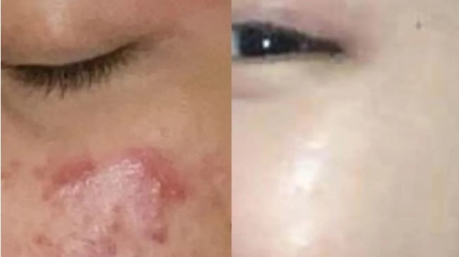 7 Cara Ampuh Atasi Jerawat dengan Produk dan Perawatan yang Tepat, Ini Rekomendasinya!