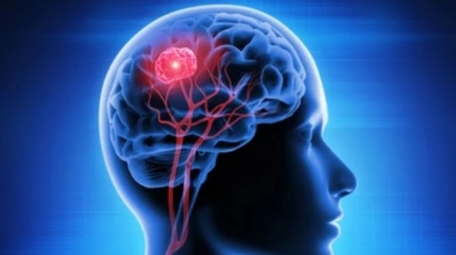 Gejala Tumor Otak yang Sering Diabaikan:  Penyebab dan Cara Deteksi Dini