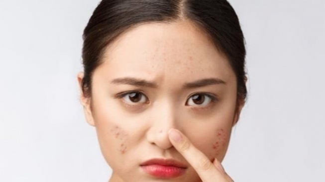 4 Soothing Toner Brand Korea Penyelamat Kemerahan pada Wajah Breakout
