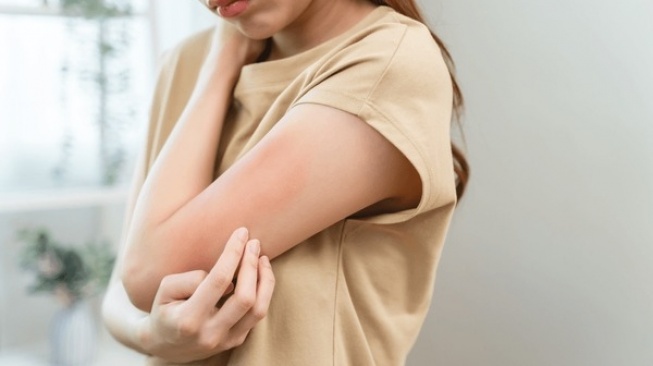 Calamine Powder untuk Apa? Ini 5 Rekomendasi Bedak Pereda Gatal dan Radang Kulit