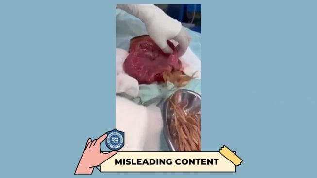 Hoaks Mi Instan sebabkan penyumbatan usus oleh cacing. [Dok. Istimewa]